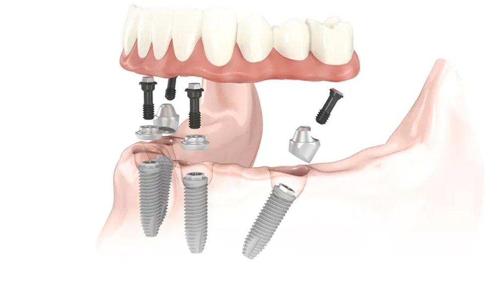 Interventi di implantologia dentale per ripristinare il sorriso