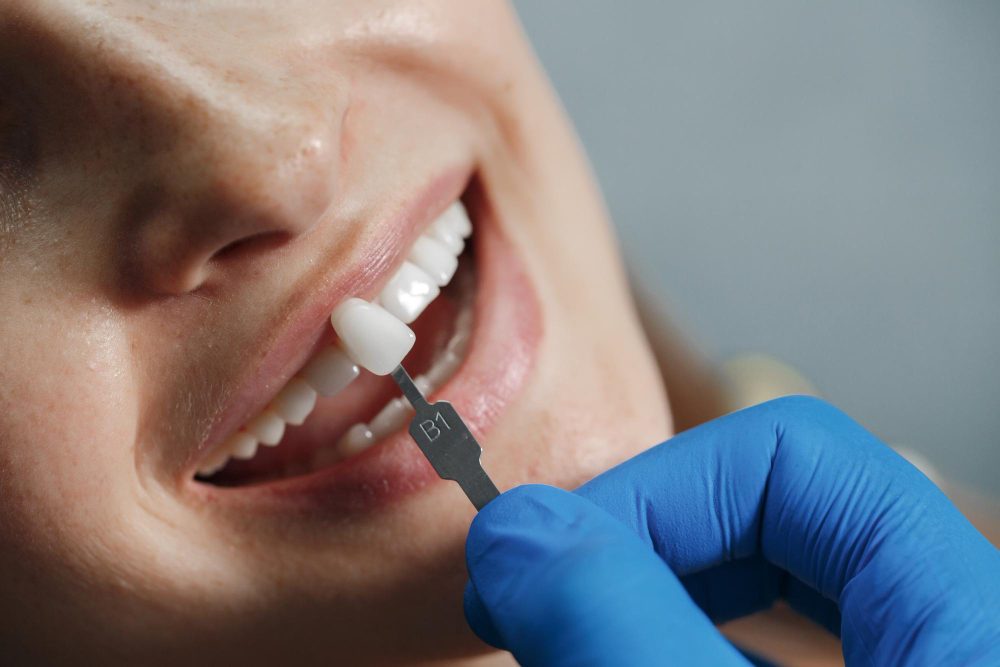 Implantologia dentale totale: una soluzione per un sorriso completo